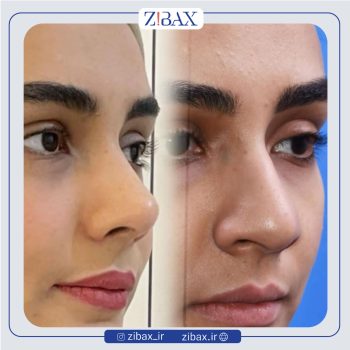 نمونه جراحی بینی دکتر حامد محمدی جراح بینی تهران