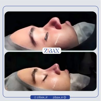 نمونه جراحی زیبایی بینی دکتر حامد محمدی جراح بینی تهران