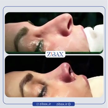 نمونه عمل بینی دکتر حامد محمدی جراح بینی در تهران