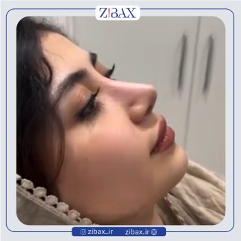 نمونه عمل بینی دکتر آرش شرفیان در تهران