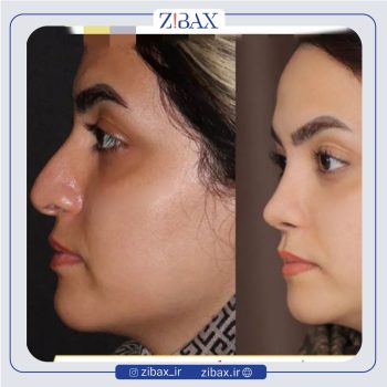 نمونه عمل بینی دکتر پارسا چراغی پور