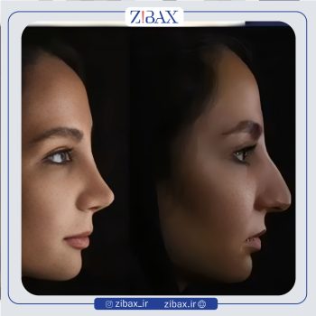 نمونه عمل بینی دکتر پارسا چراغی پور