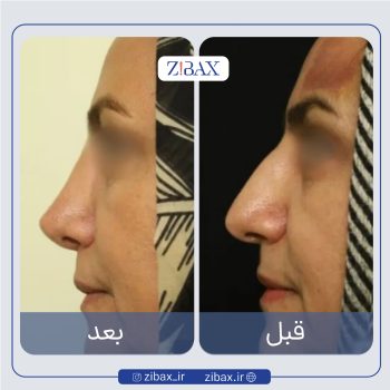 نمونه عمل بینی دکتر هادی سرمست جراح بینی در تهران
