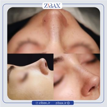 نمونه عمل بینی دکتر محمدباقر فتاحی جراح بینی در تهران