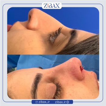 نمونه عمل بینی دکتر محمدباقر فتاحی جراح بینی در تهران
