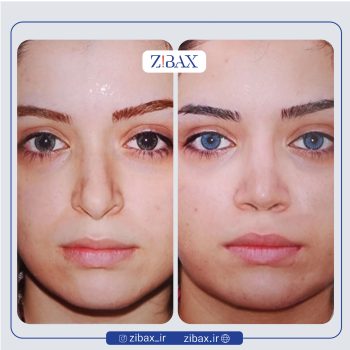 نمونه عمل بینی دکتر محمدباقر فتاحی جراح بینی در تهران