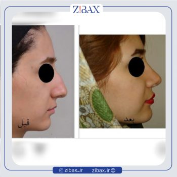 نمونه عمل بینی دکتر عبدالرسول صادقیان جراح بینی در تهران