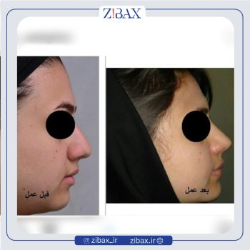 نمونه عمل بینی دکتر عبدالرسول صادقیان جراح بینی در تهران