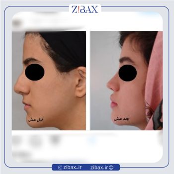 نمونه عمل بینی دکتر عبدالرسول صادقیان جراح بینی در تهران