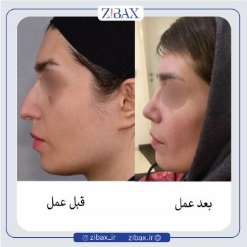 نمونه عمل بینی دکتر عبدالرسول صادقیان جراح بینی در تهران