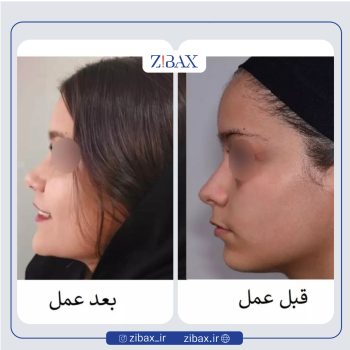 نمونه عمل بینی دکتر عبدالرسول صادقیان جراح بینی در تهران