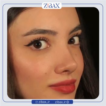 نمونه عمل بینی دکتر شروین سپنج در تهران