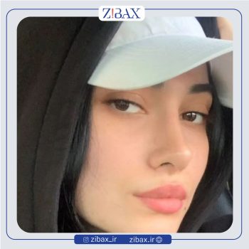 نمونه عمل بینی دکتر شروین سپنج در تهران