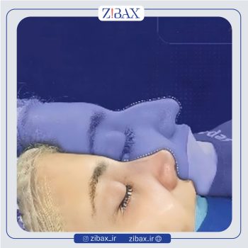 نمونه عمل بینی دکتر شروین سپنج در تهران