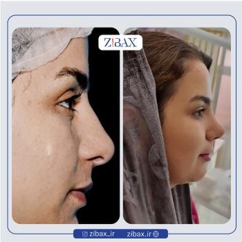 نمونه جراحی بینی دکتر علی شفیعی در تهران