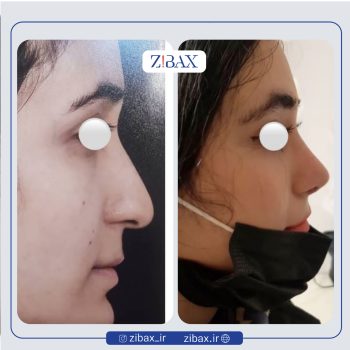 نمونه عمل بینی دکتر حسن فیروزی در تهران