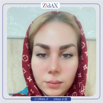 نمونه عمل بینی دکتر حسن فیروزی در تهران