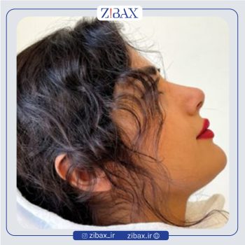 نمونه جراحی بینی با دکتر مهدی صباغی در تهران