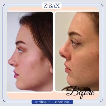 نمونه جراحی بینی دکتر حمید مزارعی در تهران