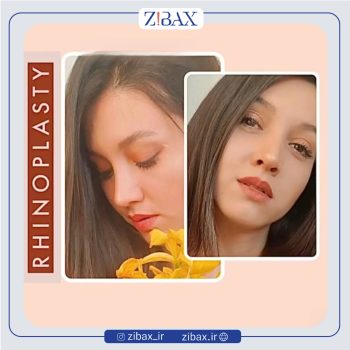 نمونه جراحی بینی دکتر حمید مزارعی در تهران