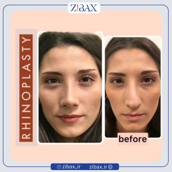 نمونه عمل بینی دکتر حمید مزارعی در تهران