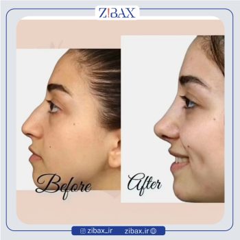 نمونه جراحی بینی دکتر حمید مزارعی در تهران