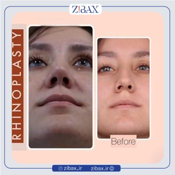 نمونه جراحی بینی دکتر حمید مزارعی در تهران