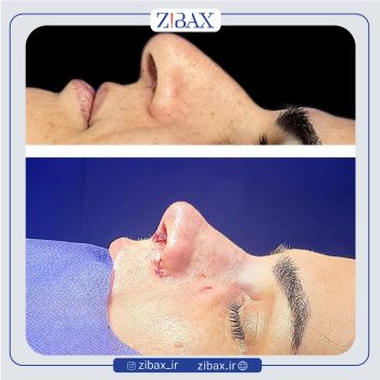 نمونه عمل بینی دکتر مجتبی نادیان در تهران