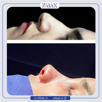 نمونه کار جراحی بینی دکتر مجتبی نادیان در تهران