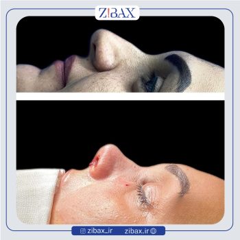 نمونه جراحی بینی دکتر مجتبی نادیان در تهران