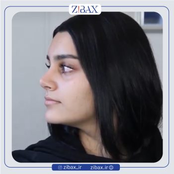 نمونه جراحی بینی دکتر رضا بدیعی در تهران