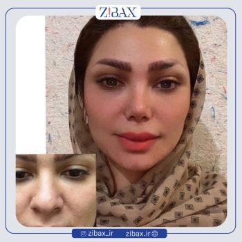 نمونه جراحی بینی دکتر رضا بدیعی در تهران