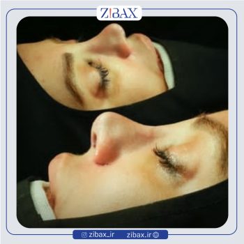 نمونه عمل بینی دکتر رضا بدیعی در تهران