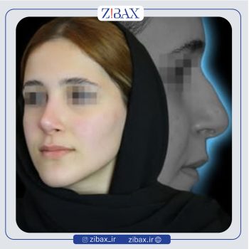 نمونه عمل بینی دکتر رضا بدیعی در تهران