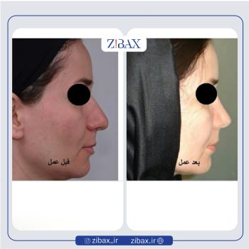 نمونه عمل بینی دکتر محمدرضا صادقیان جراح بینی در تهران