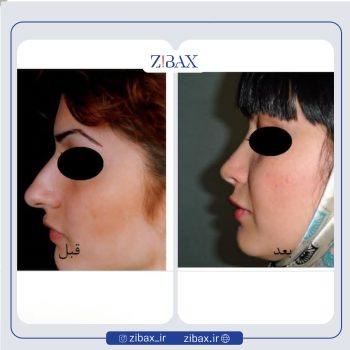 نمونه عمل بینی دکتر محمدرضا صادقیان جراح بینی در تهران