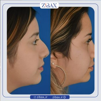 نمونه جراحی بینی با دکتر مرتضی نوری