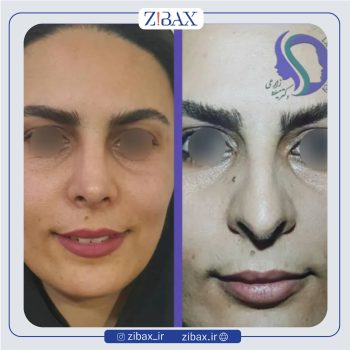 نمونه عمل بینی با دکتر میلاد زارعی