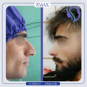 جراحی بینی مردانه با دکتر میلاد زارعی