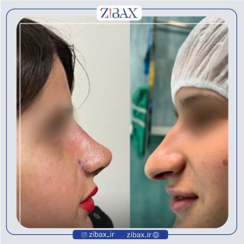 نمونه کار عمل بینی با دکتر میلاد زارعی