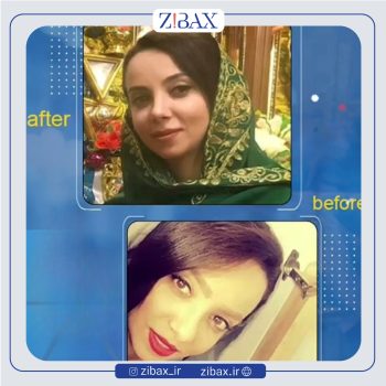 نمونه جراحی بینی دکتر صالح محبی جراح بینی در تهران