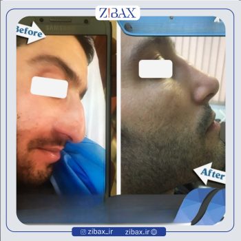نمونه جراحی بینی دکتر صالح محبی جراح بینی در تهران
