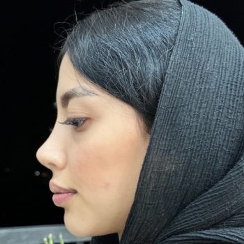 نمونه عمل بینی دکتر زرگرانی در شیراز با مشاوره زیباکس