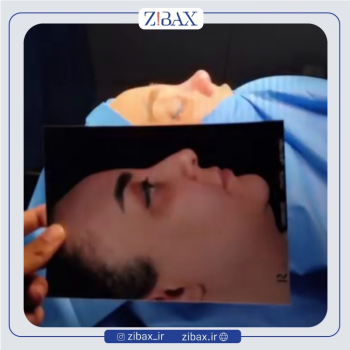 عمل بینی استخوانی با دکتر یوسف شفائی