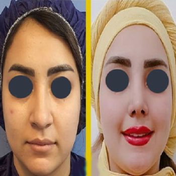 نمونه عمل بینی دکتر مسیح طالع در شیراز با مشاوره زیباکس