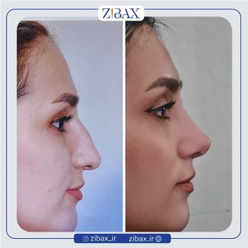 نمونه کار عمل زیبایی بینی دکتر محسن بهادر در شیراز