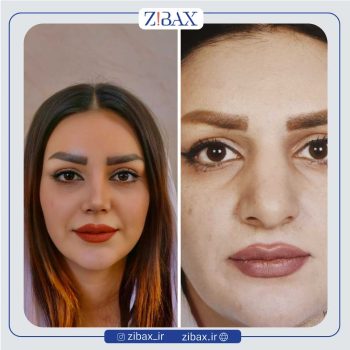 عکس نمونه کار جراحی بینی با دکتر محسن بهادر در شیراز