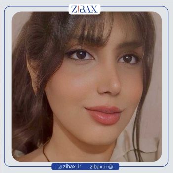 جراحی بینی توسط دکتر محسن بهادر در شیراز