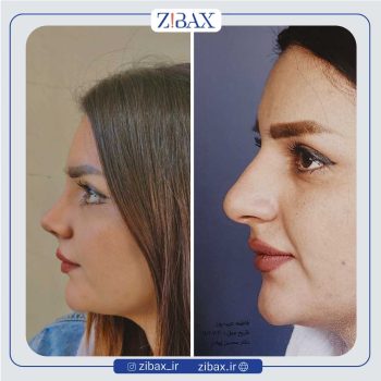 نمونه عمل زیبایی بینی دکتر محسن بهادر شیراز