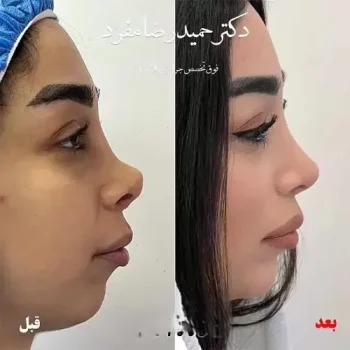 نمونه کار دکتر مفرد عمل بینی